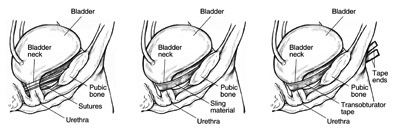 Side view diagrams of three female bladders after different types of continence surgery.  The diagram on the left shows a bladder held in place by sutures that form a supportive web for the bladder.  Labels point to the bladder, bladder neck, pubic bone, sutures, and urethra.  The diagram in the middle shows a bladder held in place by a ribbon-like sling that wraps around the bladder neck.  Labels point to the bladder, bladder neck, pubic bone, sling material, and urethra.  The diagram on the right shows a bladder held in place by a tape material wrapped around the bladder neck with tape ends emerging through incisions in the groin.  Labels point to the bladder, bladder neck, tape ends, pubic bone, transobturator tape, and urethra.