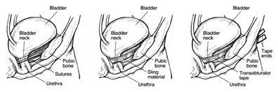 Side view diagrams of three female bladders after different types of continence surgery. The diagram on the left shows a bladder held in place by sutures that form a supportive web for the bladder. Labels point to the bladder, bladder neck, pubic bone, sutures, and urethra. The diagram in the middle shows a bladder held in place by a ribbon-like sling that wraps around the bladder neck. Labels point to the bladder, bladder neck, pubic bone, sling material, and urethra. The diagram on the right shows a bladder held in place by a tape material wrapped around the bladder neck with tape ends emerging through incisions in the groin. Labels point to the bladder, bladder neck, tape ends, pubic bone, transobturator tape, and urethra.
