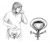 Drawing of woman coughing with pelvic bone and bladder revealed.  An inset shows shows an enlarged view of the bladder with weak pelvic floor muscles that allow urine to escape.
