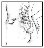 Anatomic drawing that shows the placement of an implanted nerve stimulation device in the lower abdomen of a female patient.