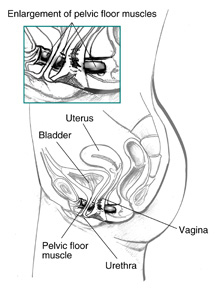 Side view diagram of female urinary tract with labels pointing to the uterus, bladder, pelvic floor muscle, urethra, and vagina.  An inset shows an enlarged view of the pelvic floor muscles.