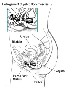 Side view diagram of female urinary tract with labels pointing to the uterus, bladder, pelvic floor muscle, urethra, and vagina. An inset shows an enlarged view of the pelvic floor muscles.