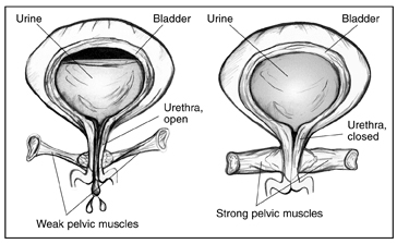 Two anatomical drawings of a bladder.  The bladder on the left has weak pelvic floor muscles that allow urine to escape.  Labels point to the bladder, urine, urethra (open), and weak pelvic muscles.  The bladder on the right has strong pelvic floor muscles that keep urine from escaping.  Labels point to the bladder, urine, urethra (closed), and strong pelvic muscles.