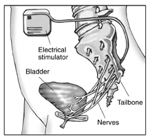 Diagram of electrical stimulation device implanted in a woman’s abdomen. Labels point to the electrical stimulator, tailbone, bladder, and nerves.