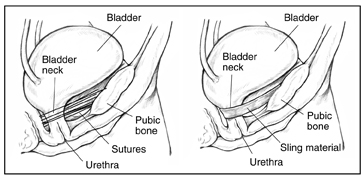 Two diagrams of bladder held in place after surgery.  On the left, the bladder is held in place by sutures.  Labels point to the bladder, bladder neck, pubic bone, sutures, and urethra.  On the right, the bladder is held in place by a sling.  Labels point to the bladder, bladder neck, public bone, sling material, and urethra.