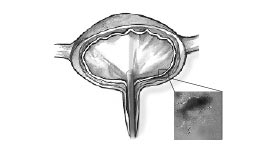 Cross-section diagram of a bladder with cystoscope visible in the urethra.  An inset shows an enlarged section of the inner bladder wall where pinpoint bleeding is visible.